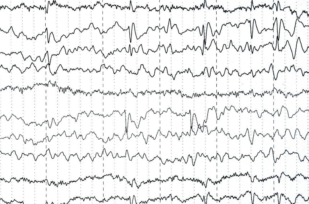 методи аналізу ЕЕГ для прогнозування епілептичних нападів